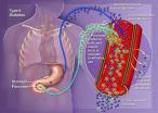 لمحة عن مرض السكري(5)